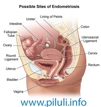 endometriosis visane