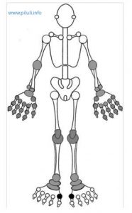 Подагра стопы