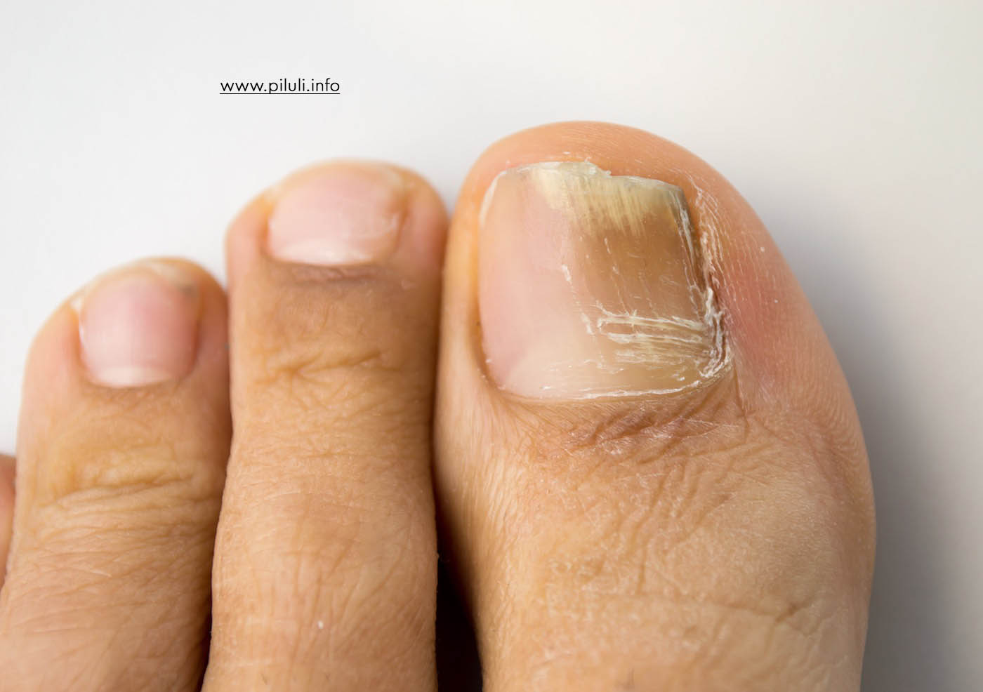 Грибковые инфекции ногтей