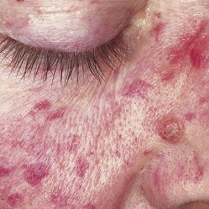 Как розацеа влияет на нос и глаза