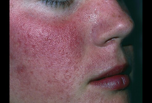 Розацеа фото