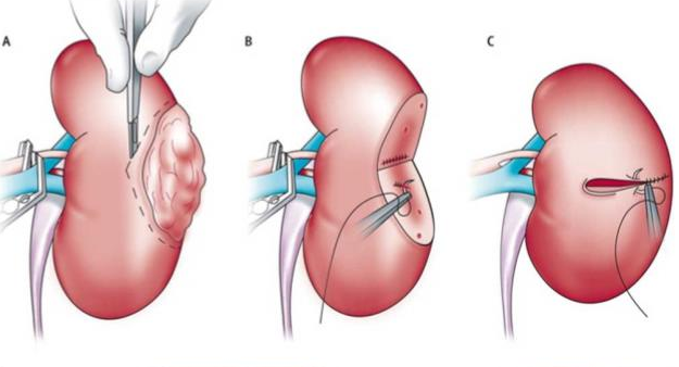Нефрэктомия – удаление почки