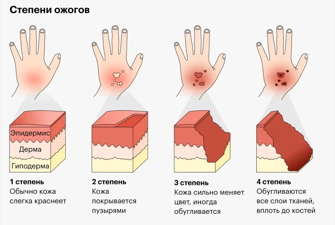 Степени ожога: как правильно лечить