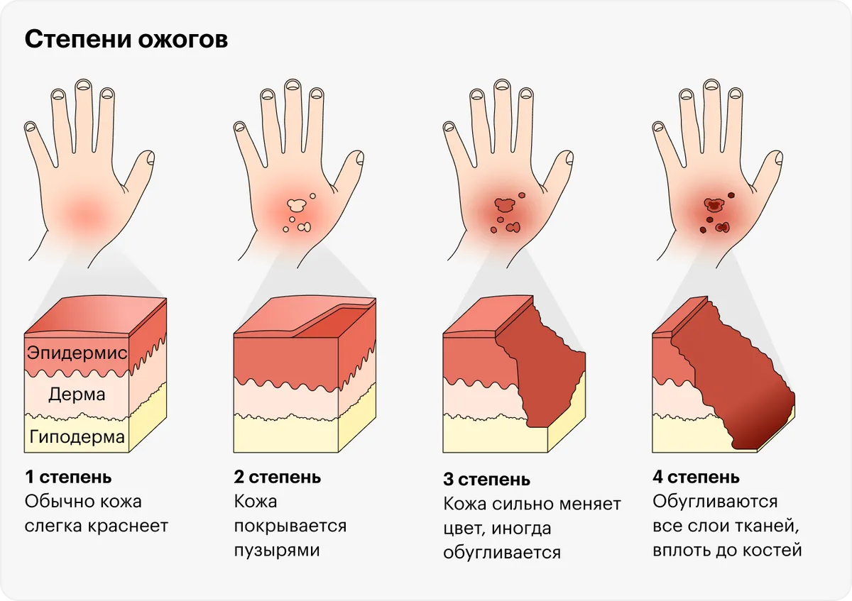 Степени ожога: как правильно лечить