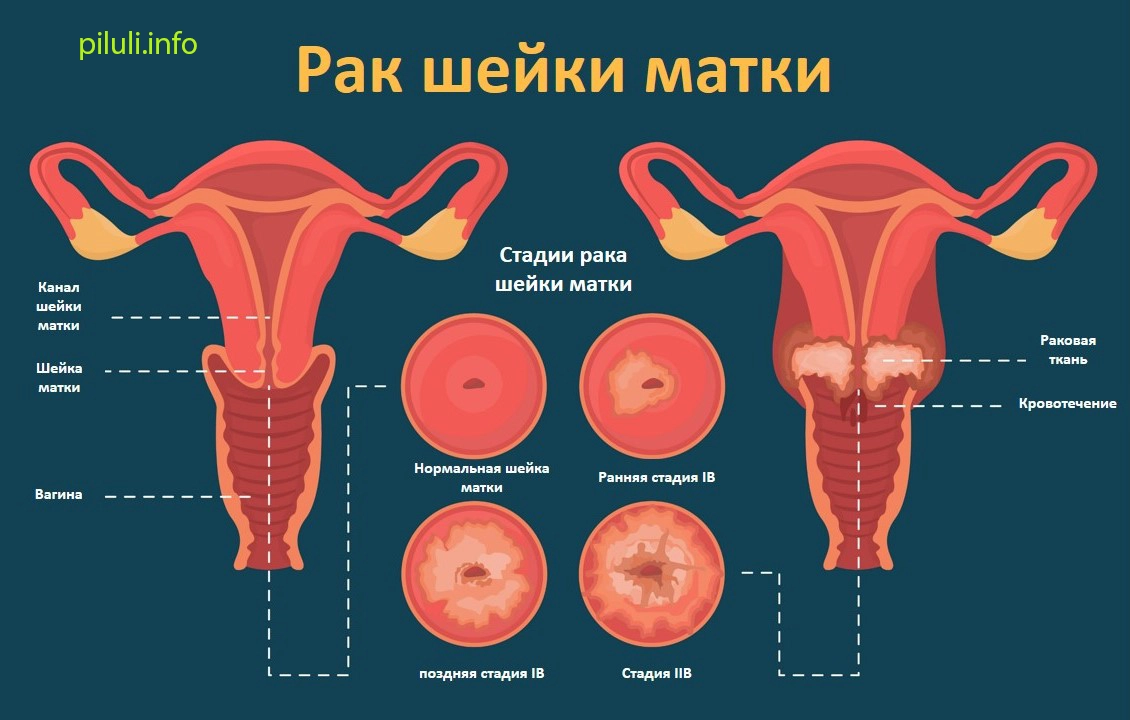 Симптомы рака влагалища